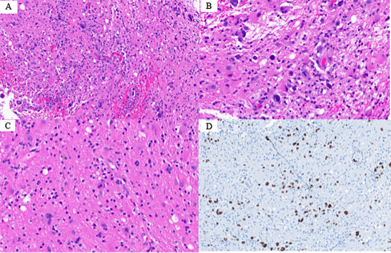Figure 2. Metastatic primary non-small cell lung carcinoma. A. Single cell infiltration of tumor cells within the white matter and cortex of the brain (4X) B. Single cell infiltration of tumor cells within the white matter and cortex of the brain (10X) C. Single cell infiltration of tumor cells