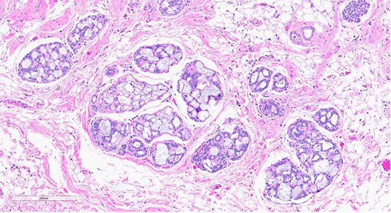Figure 1: Microscopic slides of collagenous/mucinous spherulosis. Low-power (10× objective) H&E-stained section (top) shows cribriform architecture with collagenous/mucinous spherulosis. High-power (40× objective) H&E-stained section (bottom) demonstrates further detail, with myoepithelial cells surrounding round collagenous/mucinous spherules filled with intraluminal acellular basement membrane material.